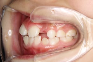 前歯部の叢生、正中のずれがあります